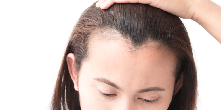 Receding hairline: Reasons, signs, Treatment and every thing - Human