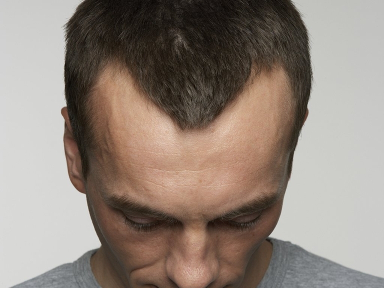 Receding hairline Reasons, signs, Treatment and every thing Human