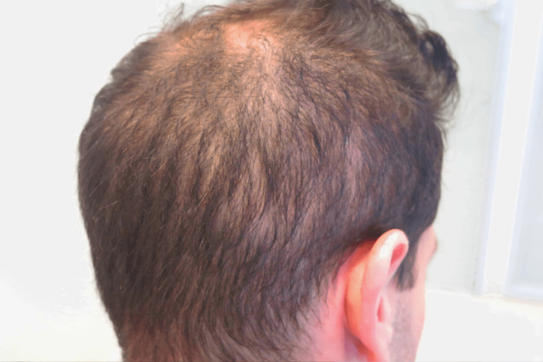 what causes thinning hair