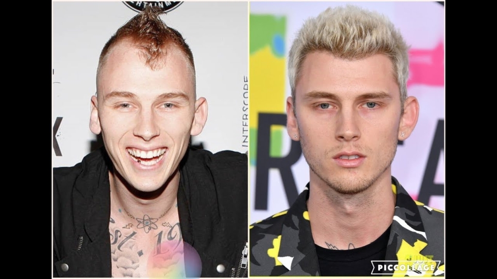 machine gun kelly hair transplant