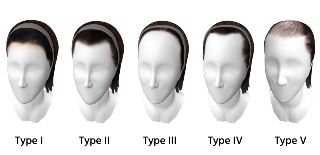 Types Of Hairlines 01 1024x497 